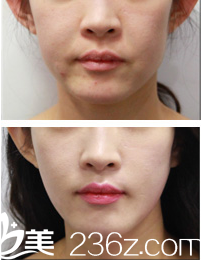 (chois)去皺真人案例效果對(duì)比