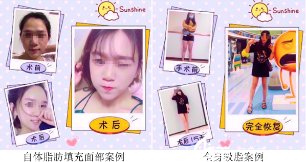 成都軍建自體脂肪填充、吸脂案例