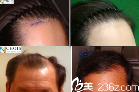崔院長(zhǎng)毛發(fā)移植真人案例效果對(duì)比 崔院長(zhǎng)毛發(fā)移植真人案例效果對(duì)比