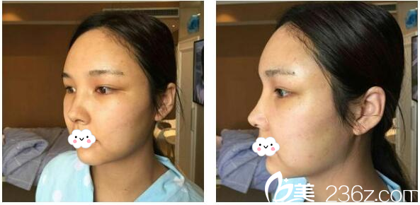 <!--<i data=20240703-sp></i>-->給我做的鼻綜合隆鼻第8天自拍