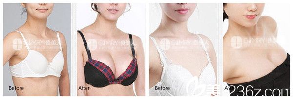 張寶成院長(zhǎng)隆胸案例 張寶成院長(zhǎng)隆胸案例