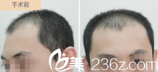 毛發(fā)移植前照片 毛發(fā)移植前照片