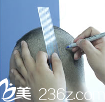 發(fā)際線移植前檢查準(zhǔn)備 發(fā)際線移植前檢查準(zhǔn)備