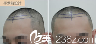 術(shù)前畫線 術(shù)前畫線