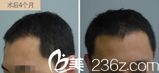 術(shù)后4個月頭發(fā)情況 術(shù)后4個月頭發(fā)情況