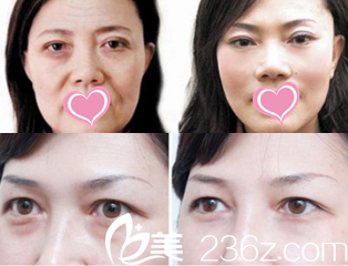 馬靜主任注射除皺案例 馬靜主任注射除皺案例