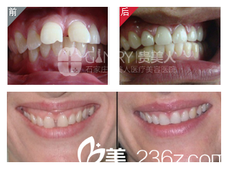 武興肖院長正畸矯正案例 武興肖院長正畸矯正案例