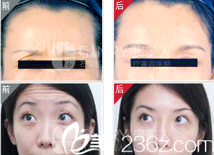 馮彥梅主任除皺案例 馮彥梅主任除皺案例