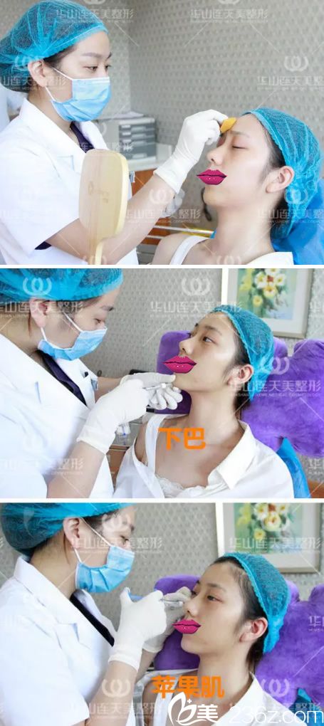 玻尿酸填充下巴和蘋果肌過程