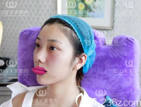 注射玻尿酸填充手術即刻效果