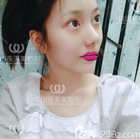 玻尿酸填充手術第1天效果