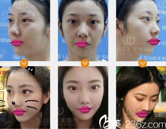 連天美李大琦玻尿酸案例