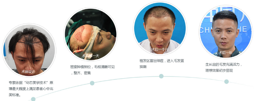 廣州倍生植發(fā)醫(yī)院發(fā)際線種植一年后案例效果