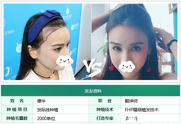 廣州倍生植發(fā)醫(yī)院廖駿發(fā)際線種植案例