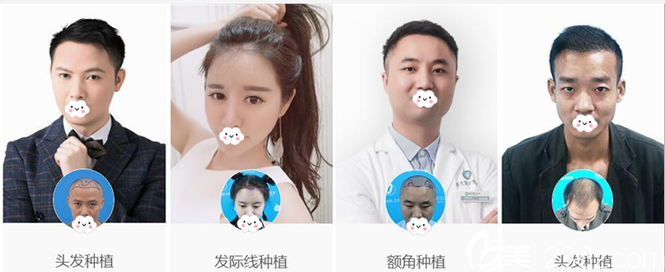 廣州倍生植發(fā)案例對(duì)比圖展示