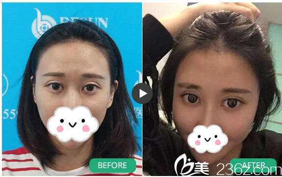 廣州倍生植發(fā)醫(yī)院廖駿發(fā)際線種植案例 廣州倍生植發(fā)醫(yī)院廖駿發(fā)際線種植案例