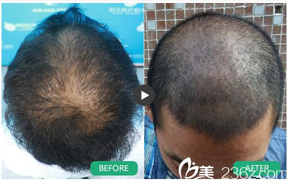 廣州倍生植發(fā)醫(yī)院廖駿頭頂毛發(fā)加密案例 廣州倍生植發(fā)醫(yī)院廖駿頭頂毛發(fā)加密案例