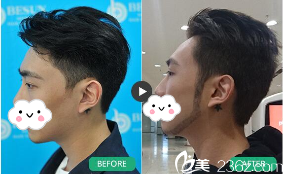 廣州倍生植發(fā)醫(yī)院廖駿絡(luò)腮胡須種植案例 廣州倍生植發(fā)醫(yī)院廖駿絡(luò)腮胡須種植案例