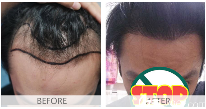 廣州倍生植發(fā)醫(yī)院楊曉男士發(fā)際線種植案例 廣州倍生植發(fā)醫(yī)院楊曉男士發(fā)際線種植案例