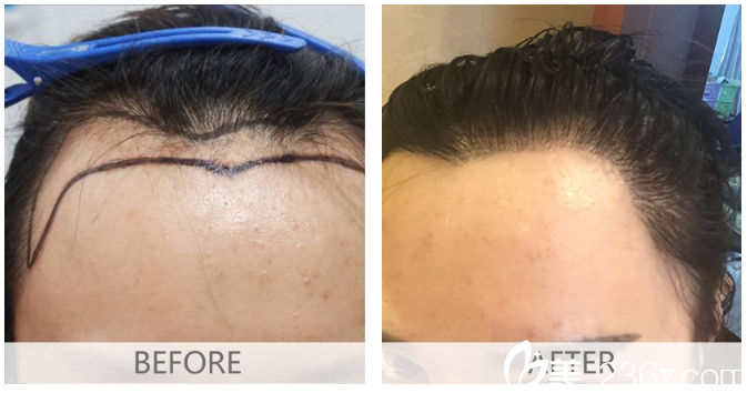 廣州倍生植發(fā)醫(yī)院楊曉女士發(fā)際線種植案例 廣州倍生植發(fā)醫(yī)院楊曉女士發(fā)際線種植案例