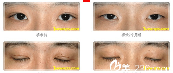 李永吉院長雙眼皮恢復(fù)案例 李永吉院長雙眼皮恢復(fù)案例