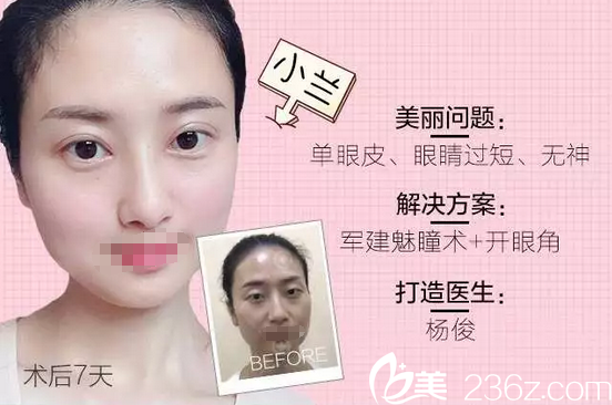 成都軍建醫(yī)院整形美容中心雙眼皮對比照
