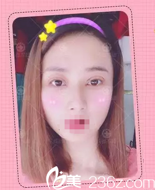 雙眼皮+開眼角術(shù)后1天照片