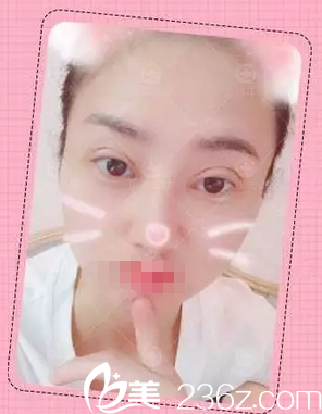 <!--<i data=20240703-sp></i>-->雙眼皮術(shù)后3天恢復(fù)情況