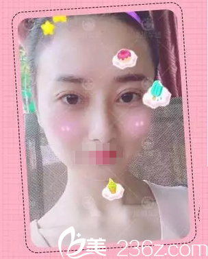 成都軍建醫(yī)院整形美容中心魅瞳術(shù)和開(kāi)眼角 讓我7天逆襲大眼萌妹