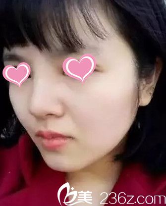看了超多隆鼻整形案例后果斷選擇石家莊貴美人 術(shù)后20天讓我蛻變少女風(fēng)格小翹鼻