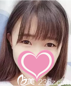 做雙眼皮術前照 做雙眼皮術前照