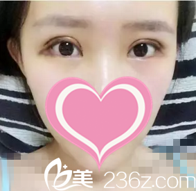 術后第五天開始消腫 術后第五天開始消腫