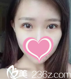 術后一周拆線 術后一周拆線