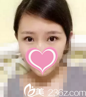 術后20天恢復效果 術后20天恢復效果