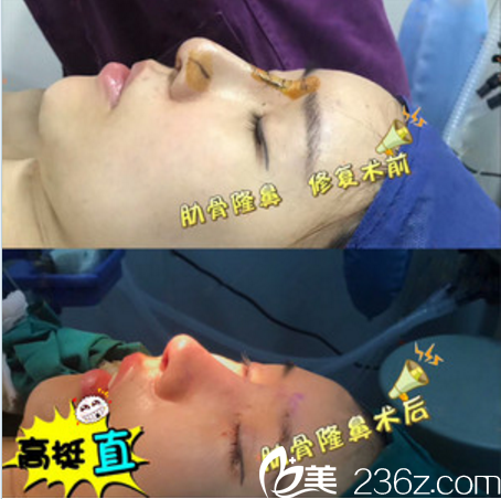 佛山曙光金子整形醫(yī)院劉云忠醫(yī)生隆鼻案例 佛山曙光金子整形醫(yī)院劉云忠醫(yī)生隆鼻案例