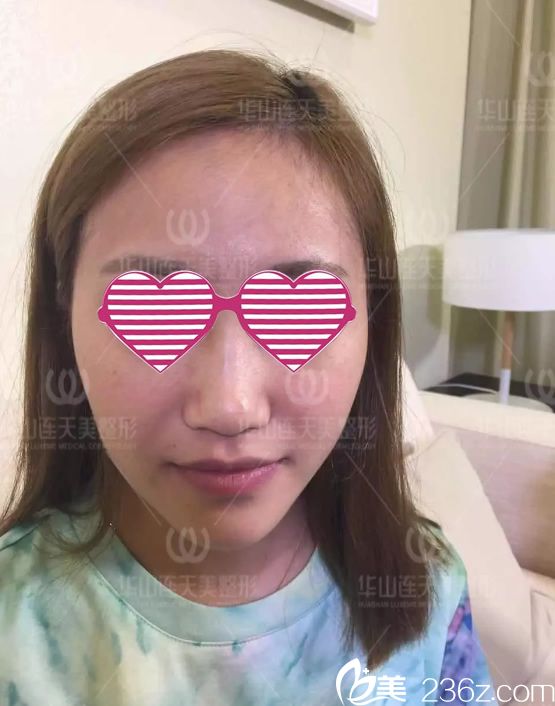 做玻尿酸填充手術前的照片 做玻尿酸填充手術前的照片