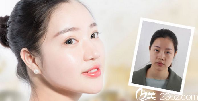 溫州芘麗芙真人整形案例效果怎么樣