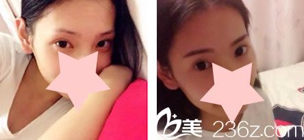 半紋眉案例效果圖(崔勁松院長案例) 半紋眉案例效果圖(崔勁松院長案例)