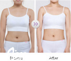瘦身案例效果
