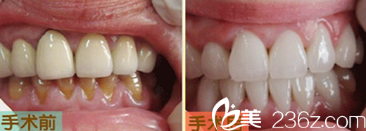 口腔醫(yī)生崔瑩瑩超聲波洗牙+牙齒糾正案例 口腔醫(yī)生崔瑩瑩超聲波洗牙+牙齒糾正案例