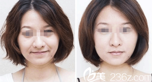 注射除皺效果對比