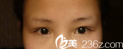 雙眼皮失敗照片 雙眼皮失敗照片