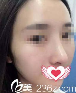 看我找?？邬i愛張淑艷做的鼻綜合一個月后，側(cè)顏挺挺的線條感超強