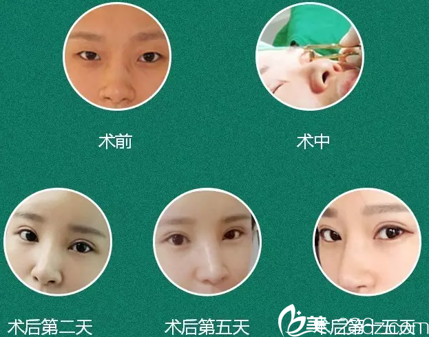 王章霞醫(yī)生雙眼皮案例 王章霞醫(yī)生雙眼皮案例