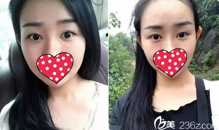 找無錫施爾美王章霞做雙眼皮+開眼角眼綜合9800元是不是貴了