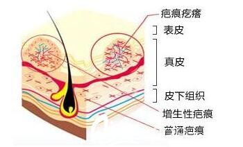 南寧韓星整形醫(yī)院醫(yī)生講解疤痕分類 南寧韓星整形醫(yī)院醫(yī)生講解疤痕分類