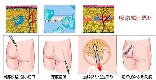 南寧韓星講解吸脂手術原理 南寧韓星講解吸脂手術原理