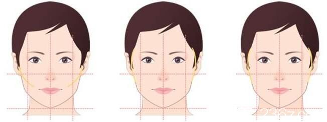 南寧韓星面部輪廓手術(shù)美學(xué)標(biāo)準(zhǔn) 南寧韓星面部輪廓手術(shù)美學(xué)標(biāo)準(zhǔn)