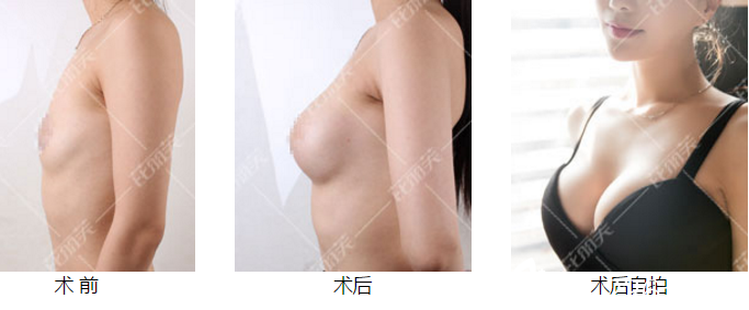 溫州芘麗芙皮先榮院長(zhǎng)隆胸案例 溫州芘麗芙皮先榮院長(zhǎng)隆胸案例