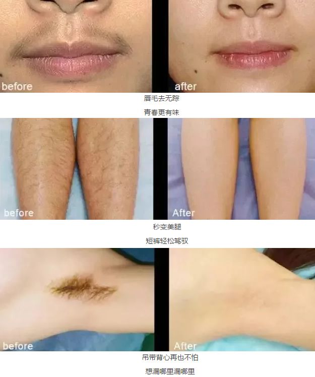 溫州藝星激光脫毛真人<span style=